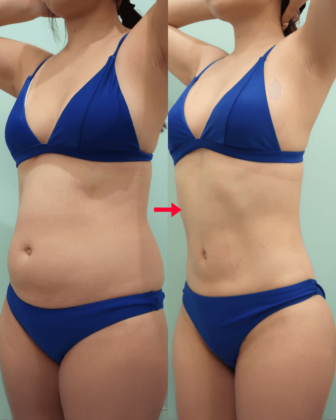 Before-and-after abdominal and trunk liposuction case