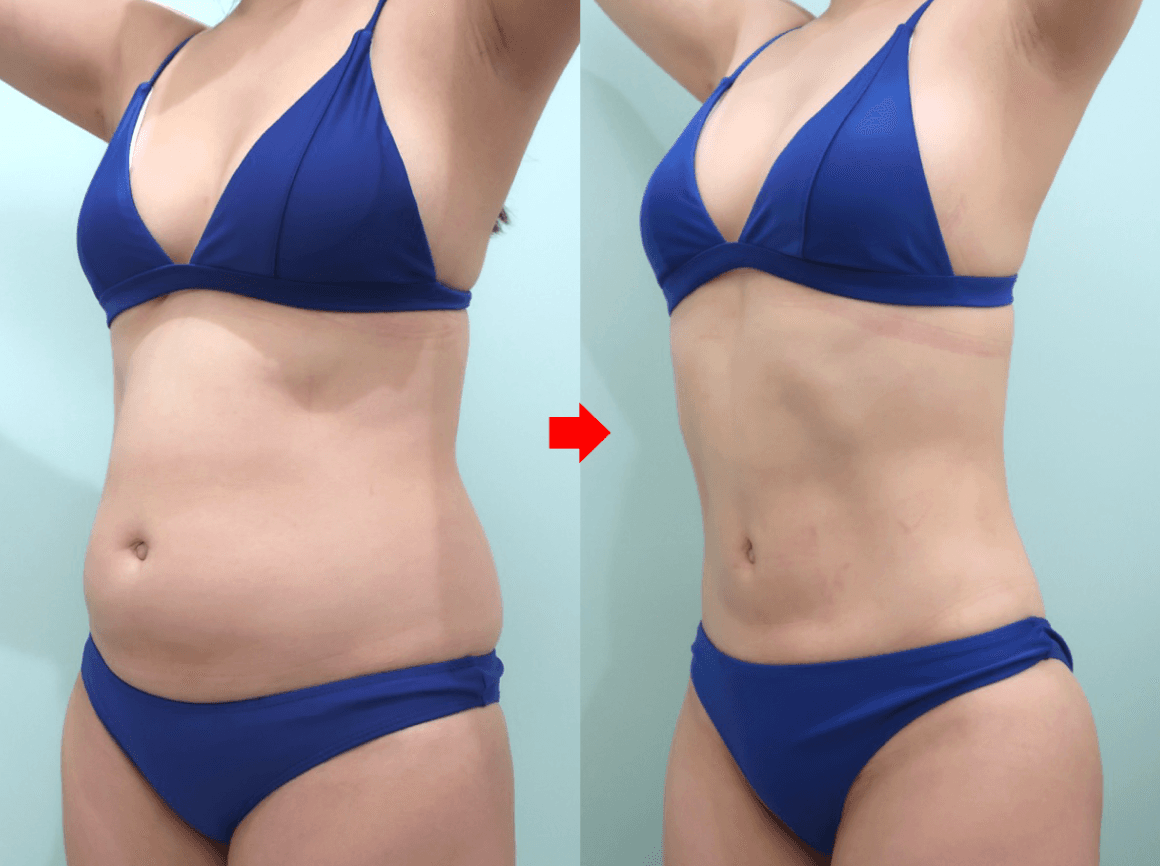 Abdominal liposuction before and six months after surgery