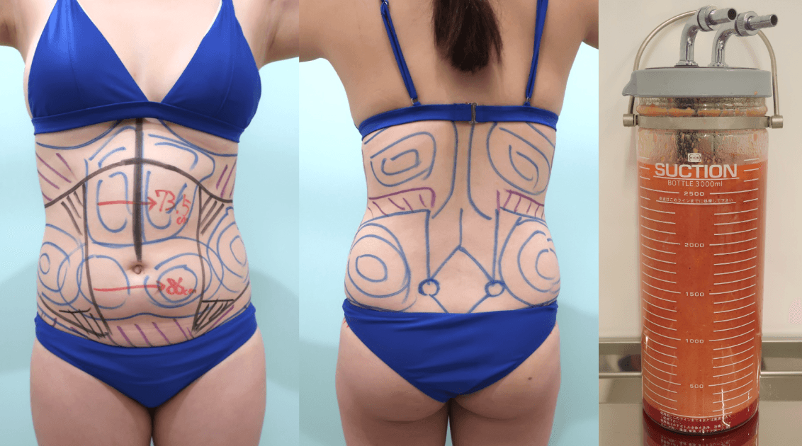 Preoperative liposuction design and removed fat
