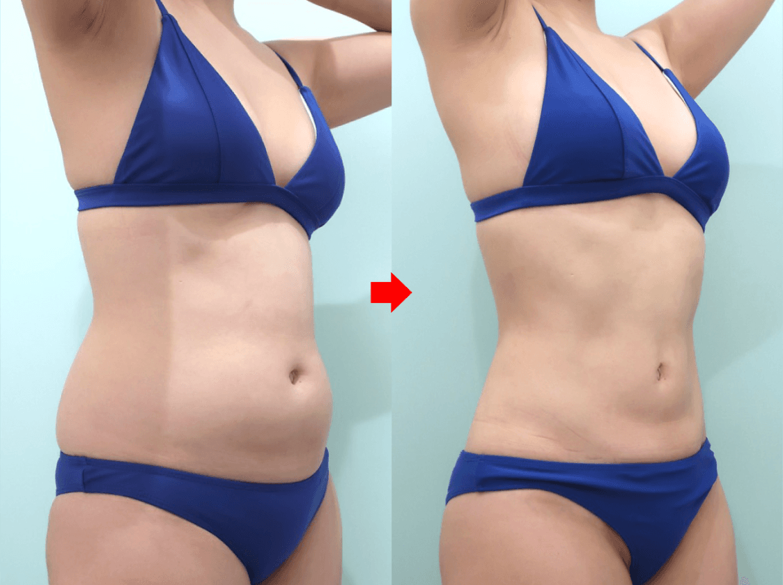 Right oblique abdominal liposuction comparison