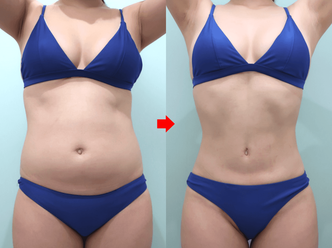Front abdominal liposuction comparison