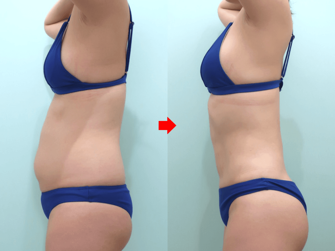 Left-side abdominal liposuction comparison