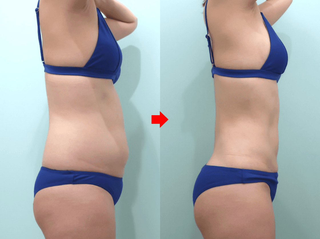 Right-side abdominal liposuction comparison