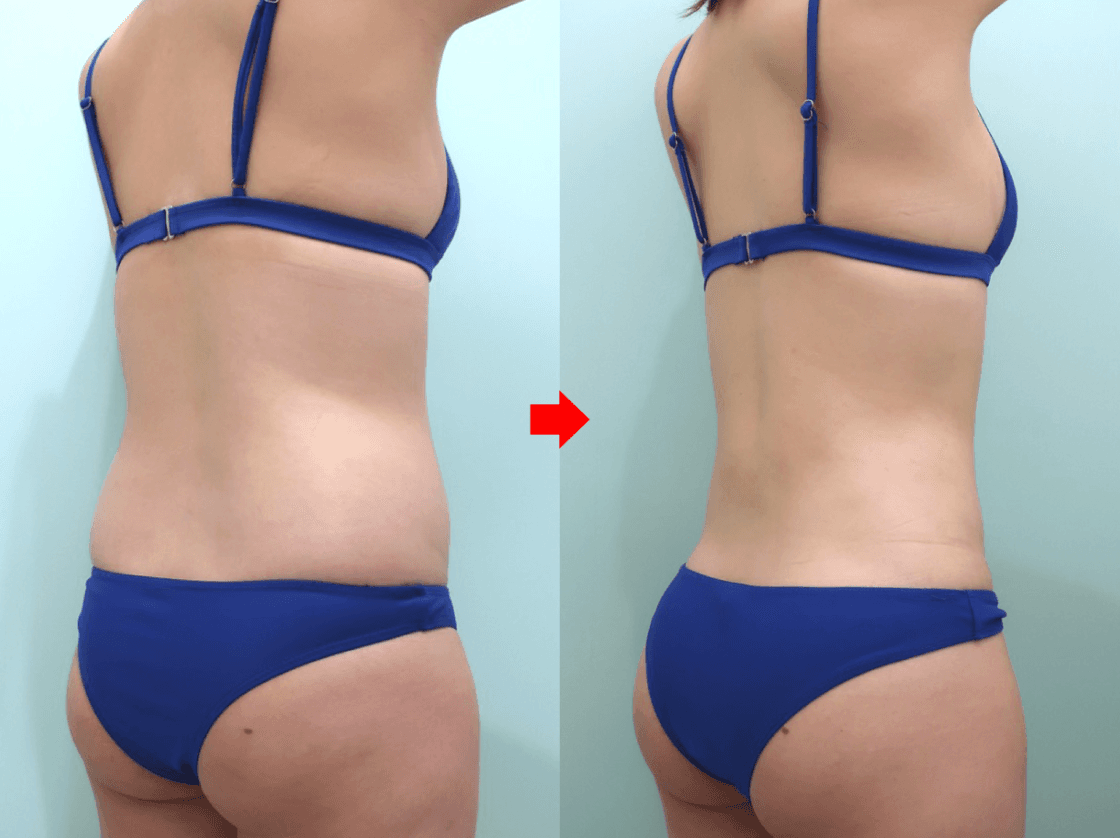 Rear oblique liposuction comparison