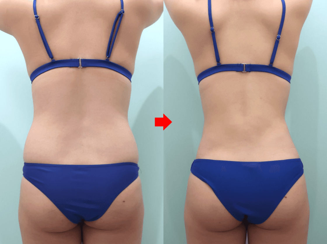 Rear liposuction comparison