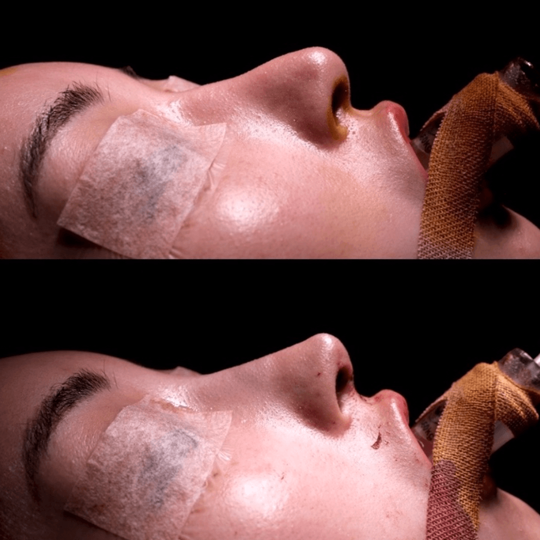 Photos before and immediately after complex revision surgery, tip plasty, auricular cartilage grafting, and alar rim lowering