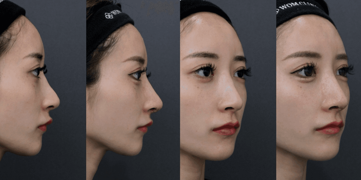 Before-and-after photos of complex revision surgery, tip plasty, auricular cartilage grafting, and alar rim lowering