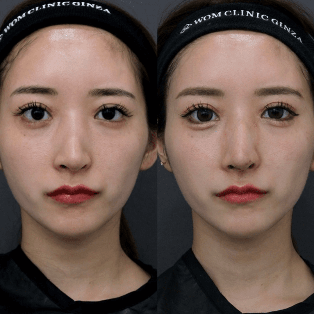 Before-and-after photos of complex revision surgery, tip plasty, auricular cartilage grafting, and alar rim lowering