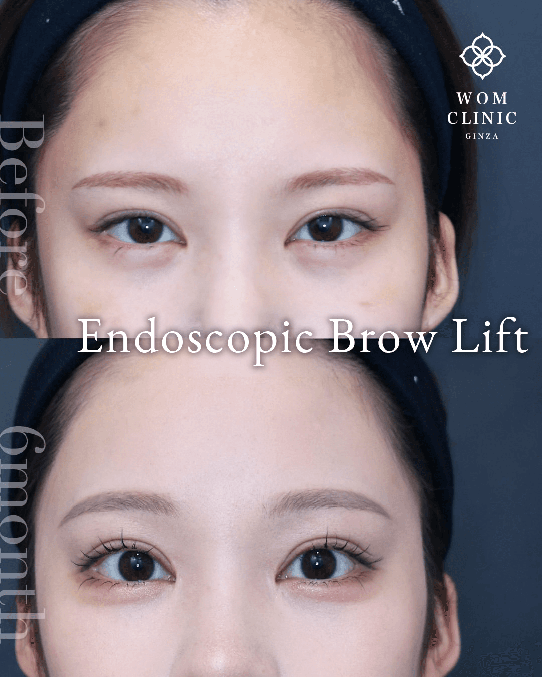 Endoscopic brow lift (forehead lift): before and one month after
