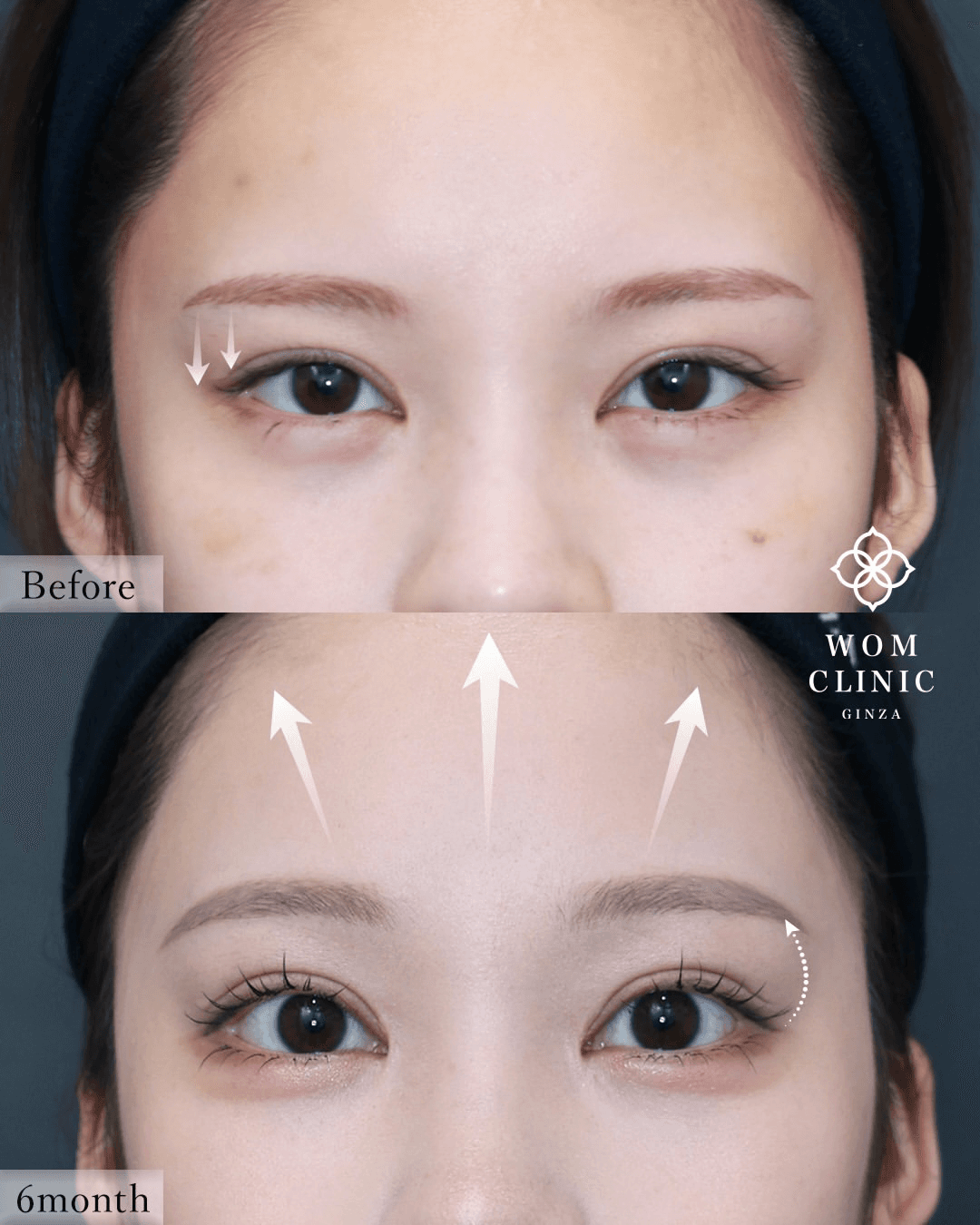 Endoscopic brow lift (forehead lift): before and six months after