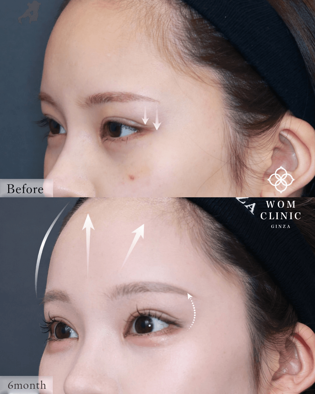 Endoscopic brow lift (forehead lift): before and six months after