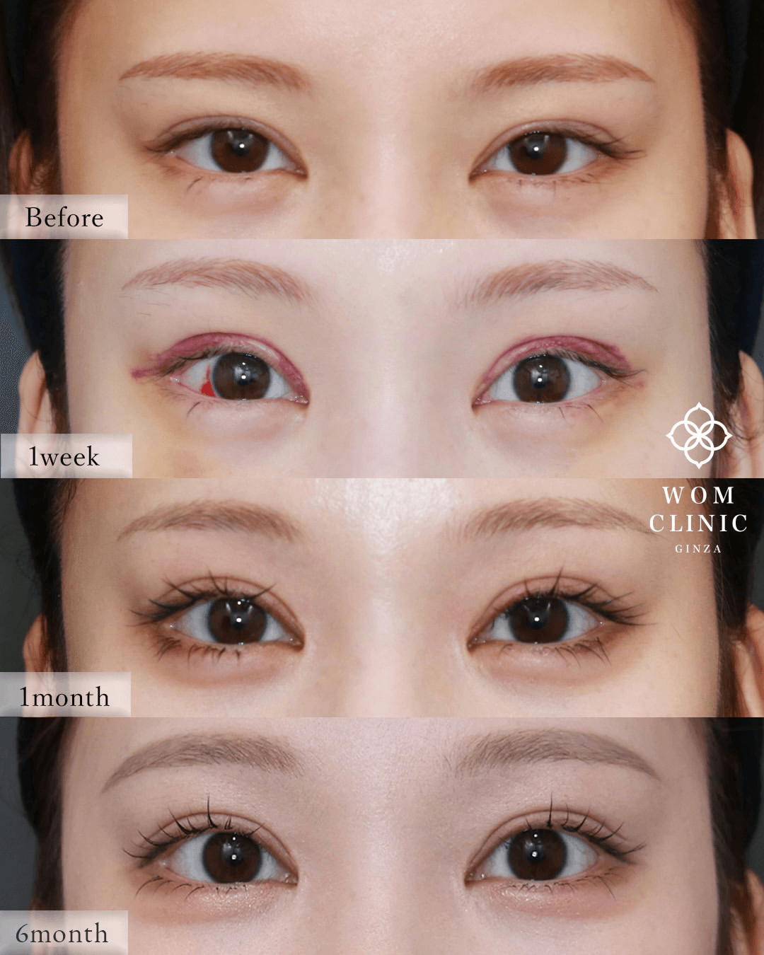 Endoscopic brow lift (forehead lift): recovery time photos before surgery, one week after to six months after