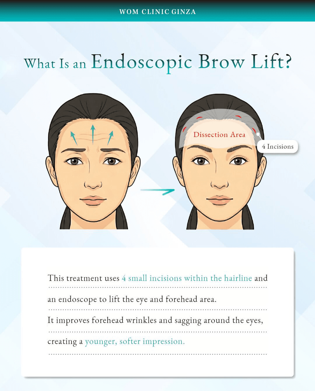 ◆ What is an endoscopic brow lift?