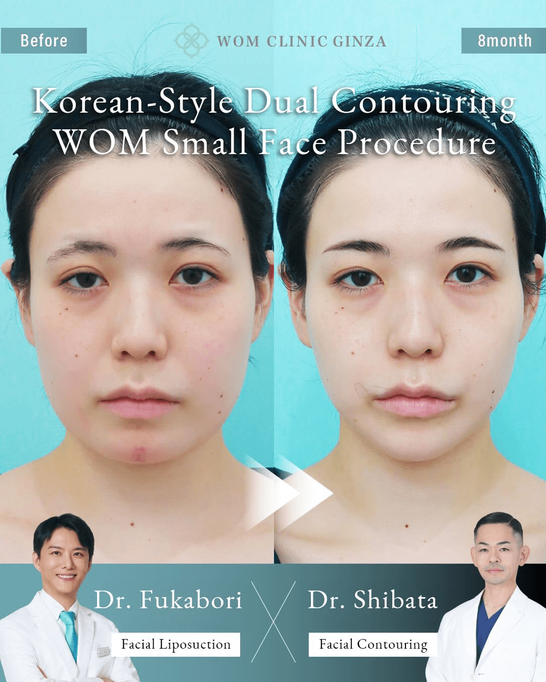 Before and 8 months after two-part facial contouring and liposuction