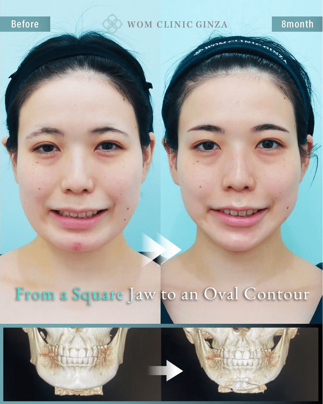 Before and 8 months after two-part facial contouring and liposuction