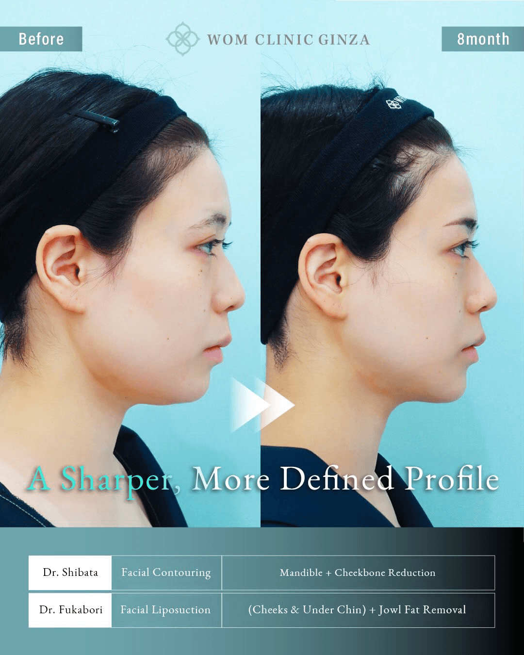 Before and 8 months after two-part facial contouring and liposuction — full side view