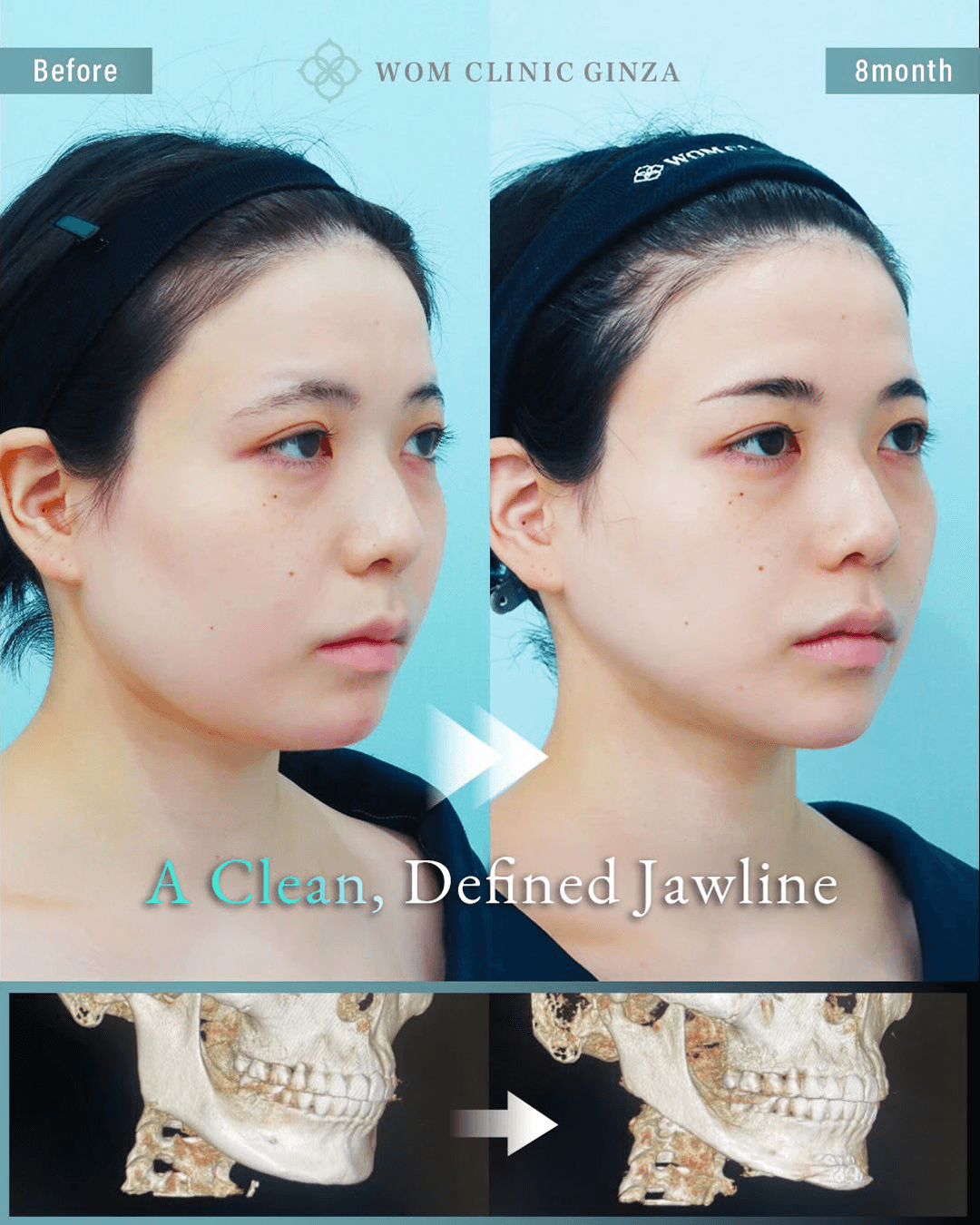 Before and 8 months after two-part facial contouring and liposuction — oblique view