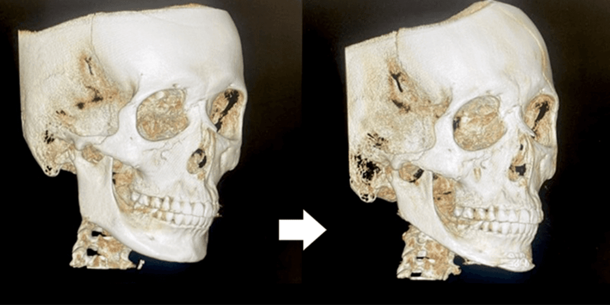 Preoperative and postoperative CT images of two-part facial contouring