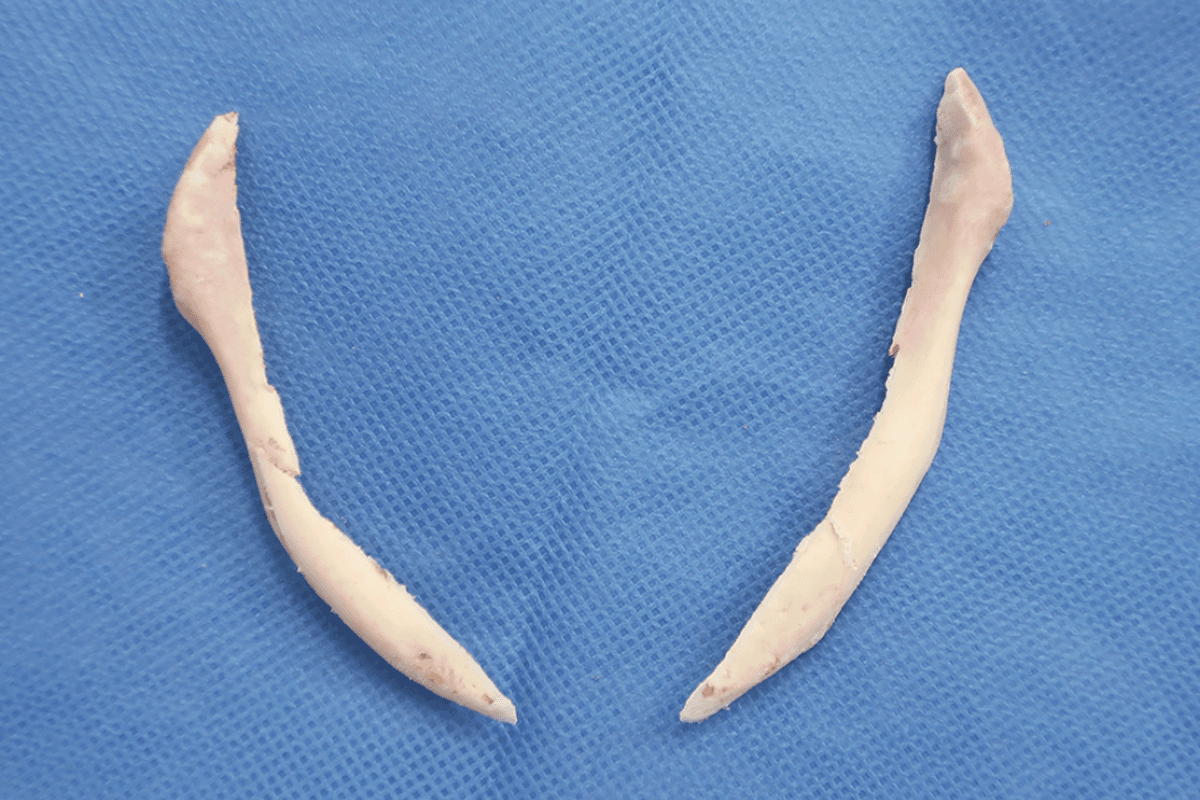 Bone removed during two-part facial contouring