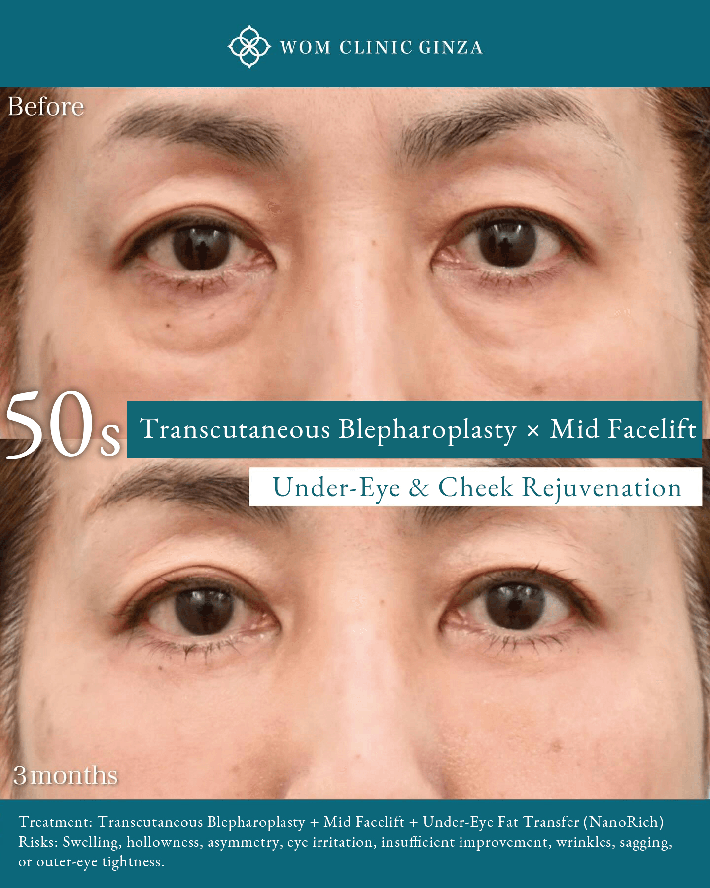 Before and 3 Months After the Transcutaneous Blepharoplasty × Midface Lift × NanoRich