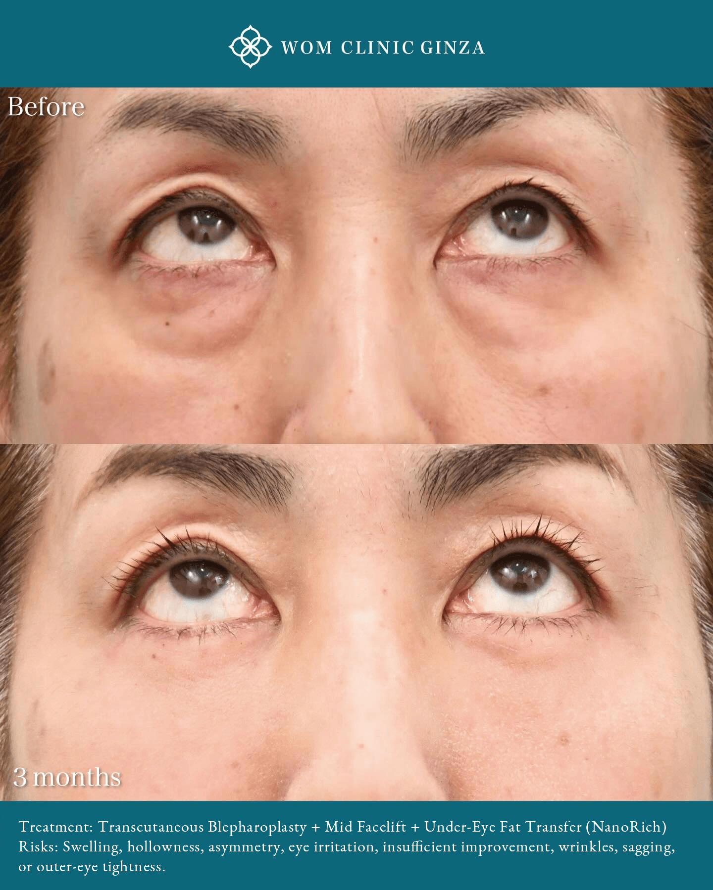 Before and three months after transcutaneous Hamra surgery, a midface lift, and NANORICH treatment