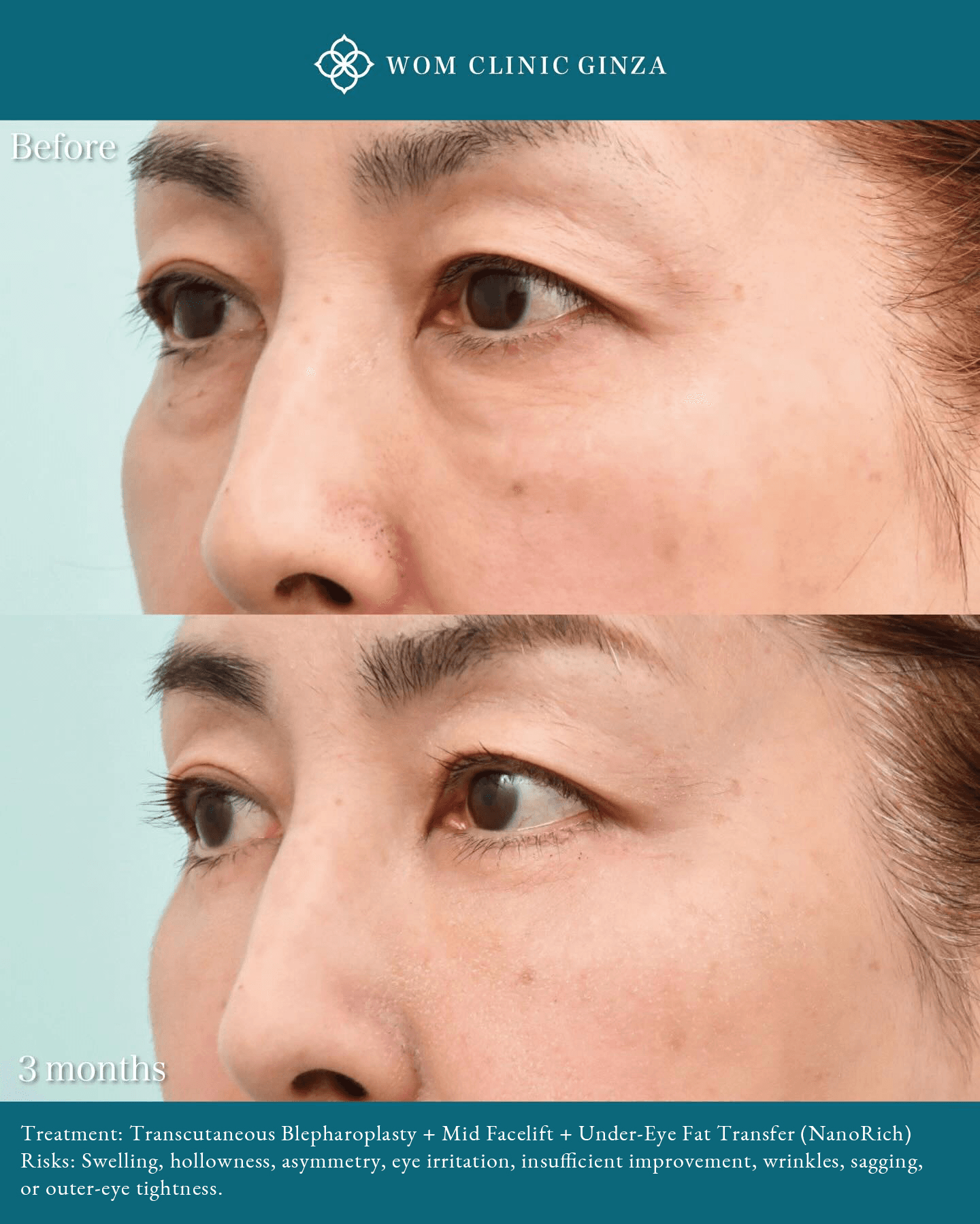 Before and three months after Transcutaneous Blepharoplasty, a midface lift, and NANORICH treatment