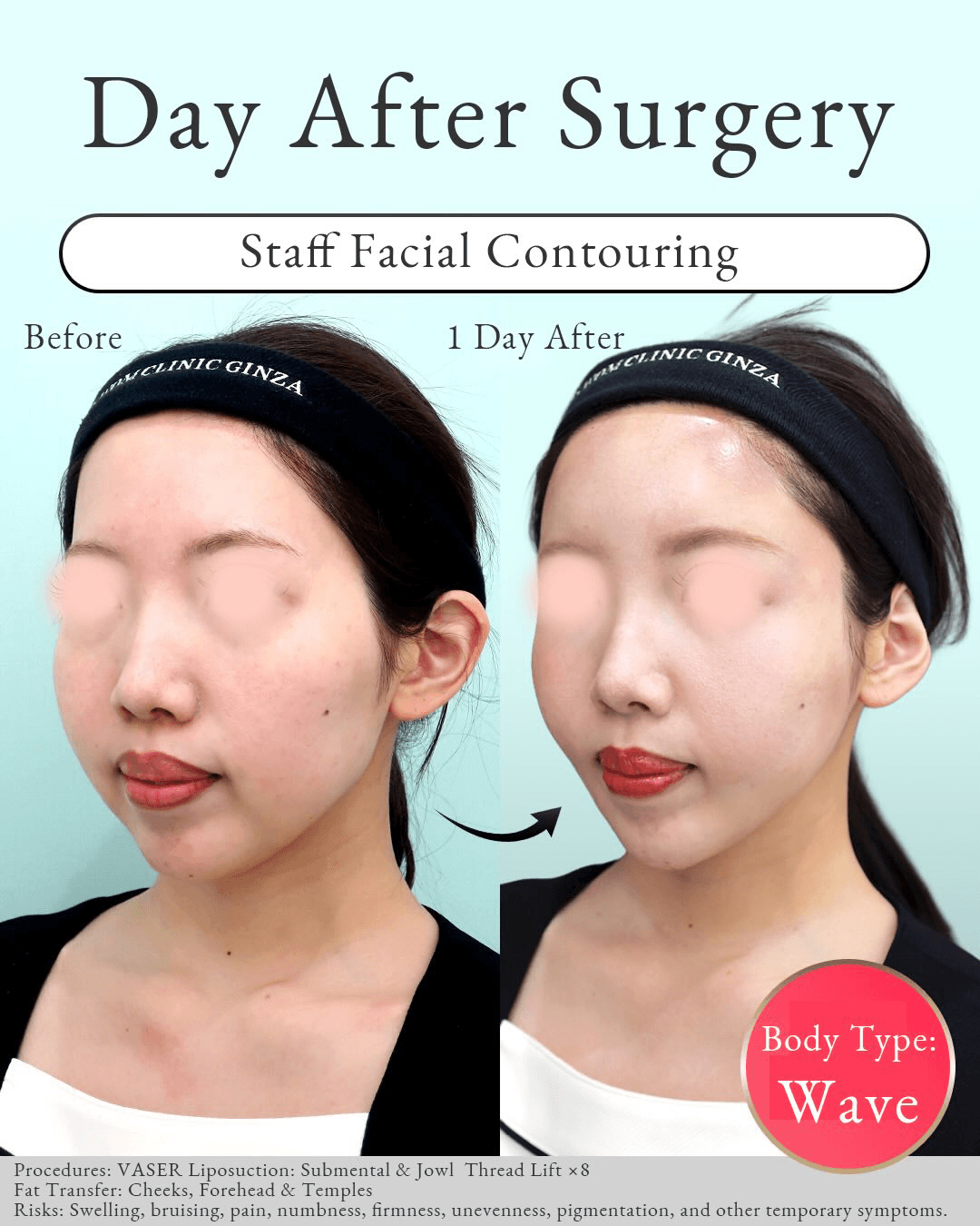 Before-and-after results of facial contouring combining liposuction and fat grafting
