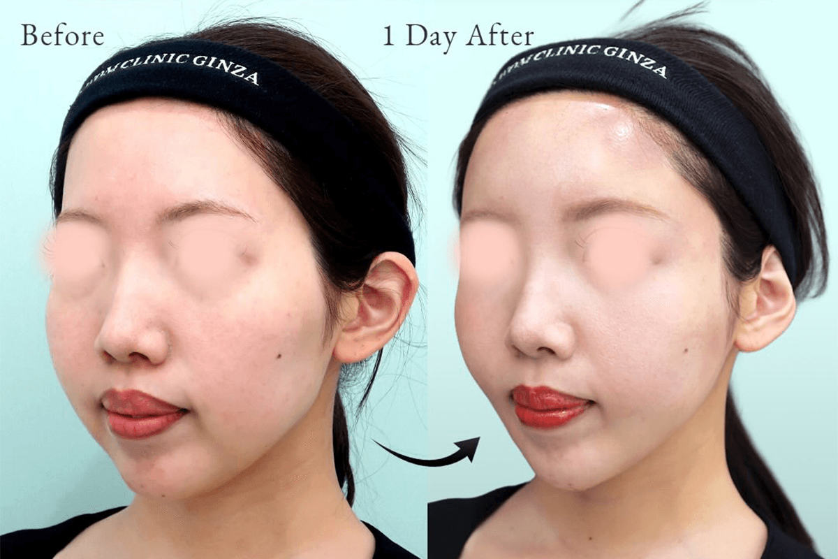 Before-and-after case photos taken one day after extended submental and jowl fat liposuction with fat grafting to the forehead, temples, and hollow cheeks