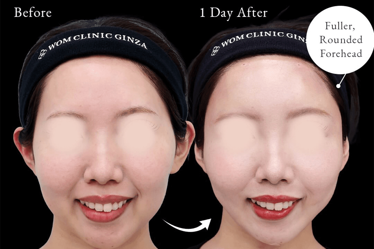 Before-and-after case photos taken one day after extended submental and jowl fat liposuction with fat grafting to the forehead, temples, and hollow cheeks