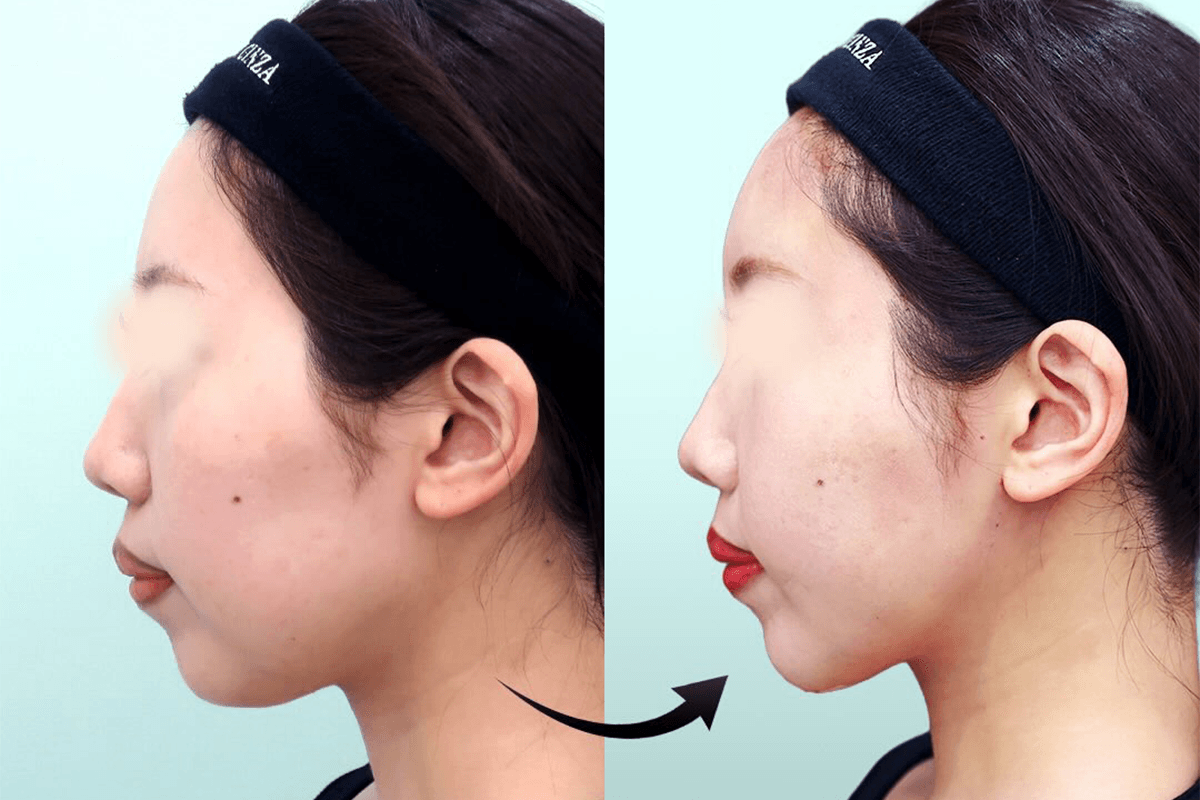 Before-and-after case photos taken one day after extended submental and jowl fat liposuction with fat grafting to the forehead, temples, and hollow cheeks
