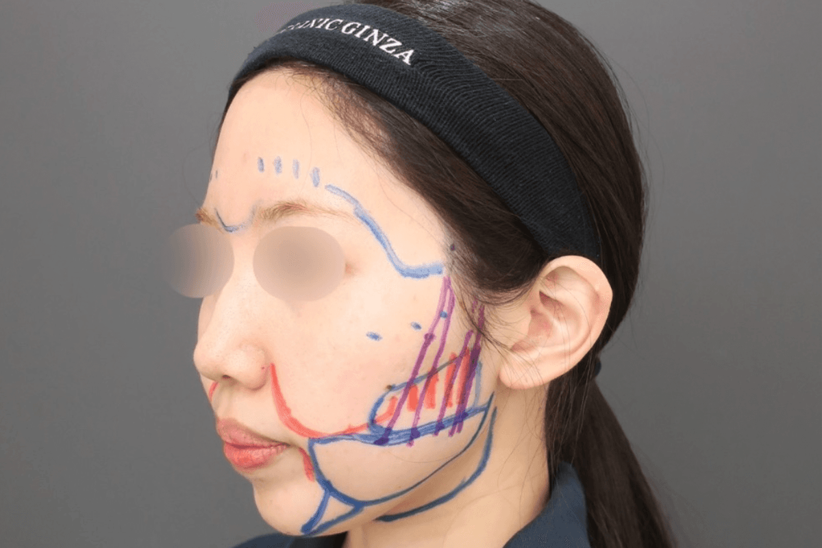 Preoperative design photo for extended submental and jowl fat liposuction with fat grafting to the forehead, temples, and hollow cheeks