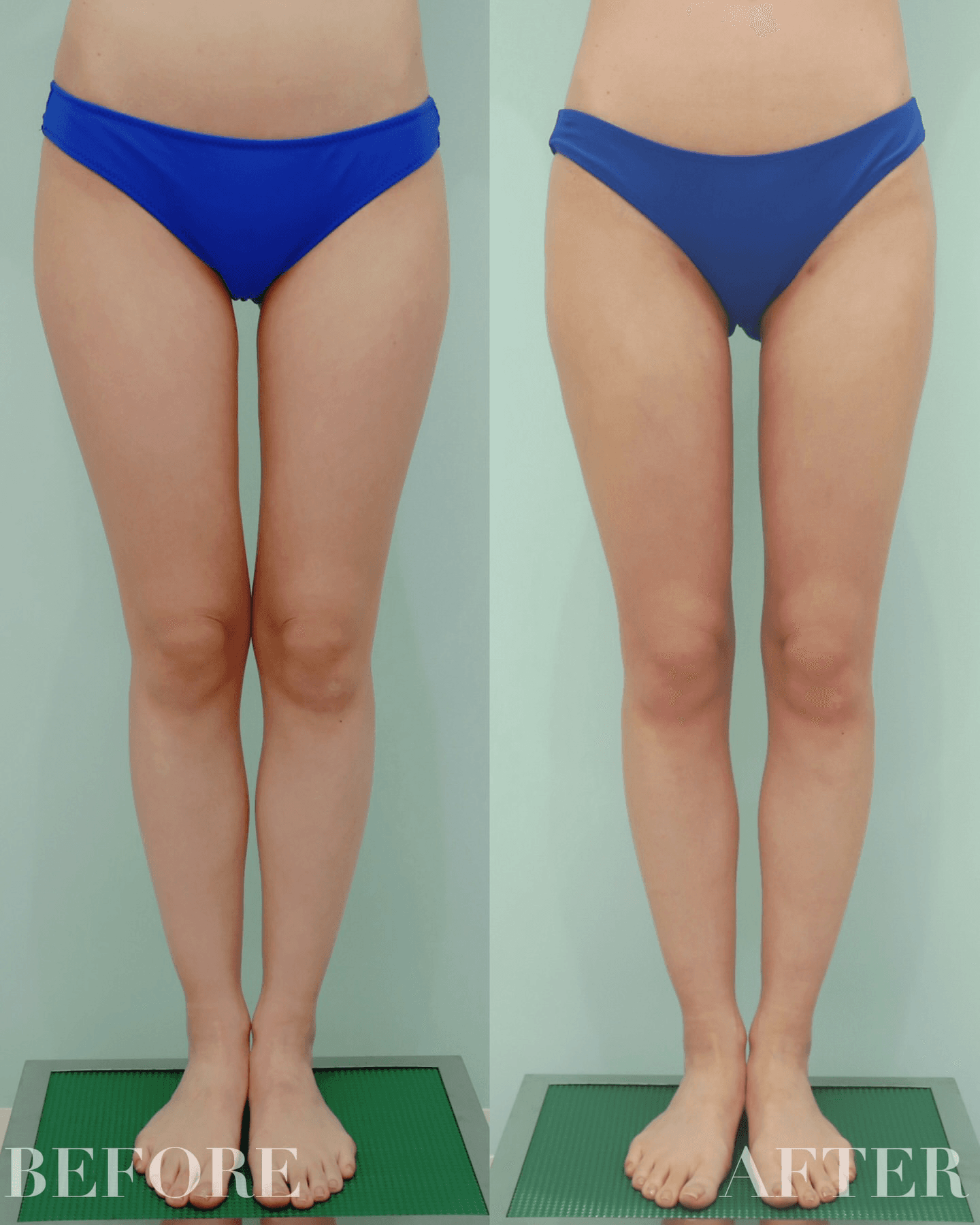 The Key to Beautiful Legs Lies in the Thigh Gap: See the Real Recovery Journey Through Three Months After Surgery.