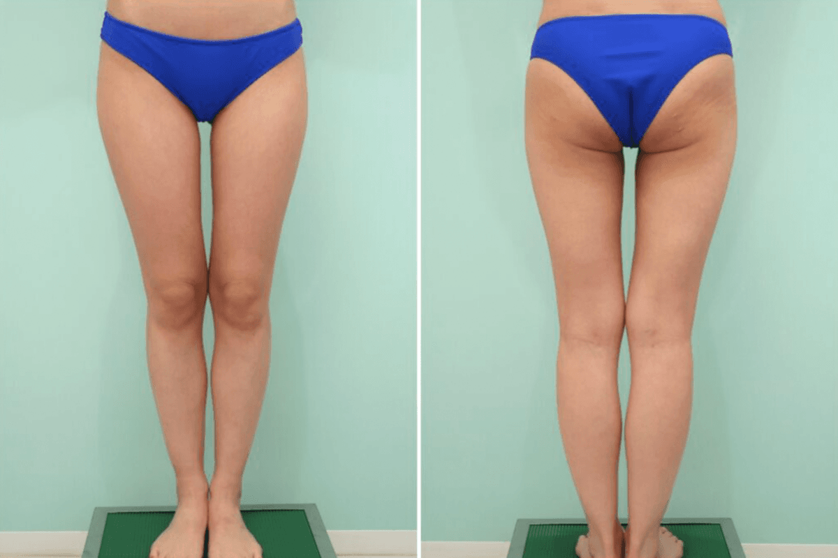 Before Liposuction: Full Thighs, Lower Buttocks, and Knees (Above/Inner)