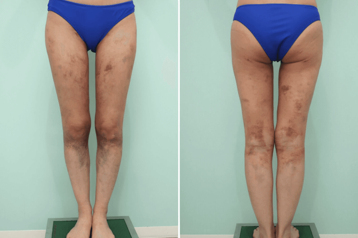 One Week After Liposuction of the Full Thighs, Lower Buttocks, and Knees (Above/Inner): Bruising and Swelling During Recovery