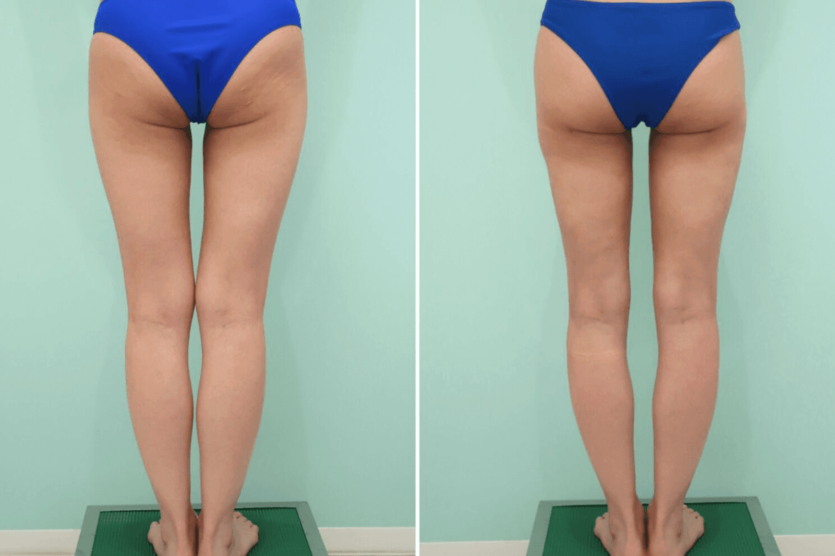 Before-and-After Photos: Liposuction of the Full Thighs, Lower Buttocks, and Knees (Above/Inner)