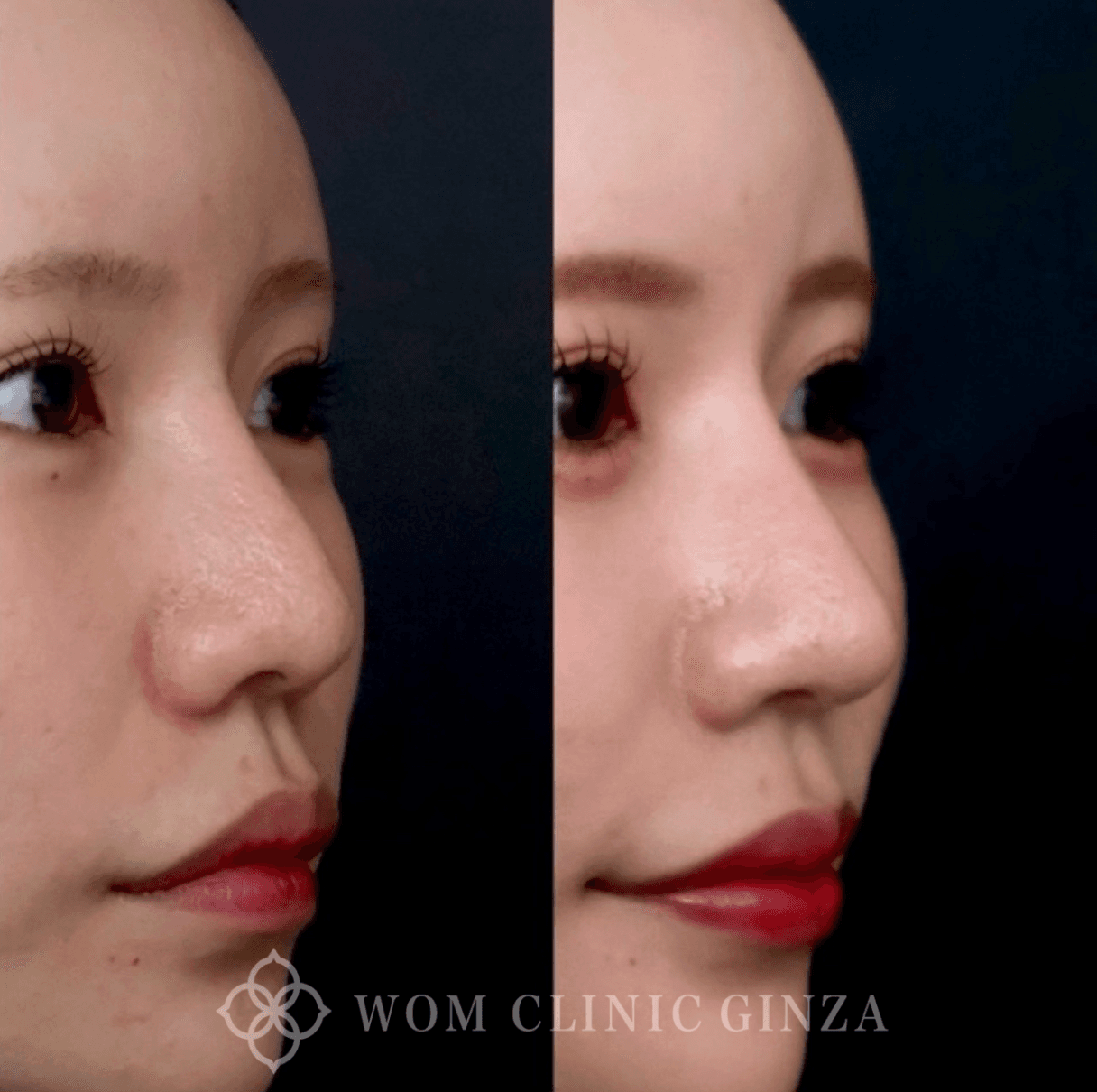Before-and-after revision rhinoplasty with nasal tip refinement and alar rim lift