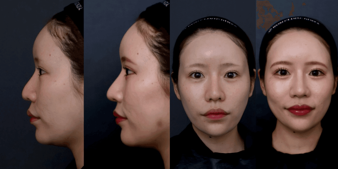 Before-and-After Photos: Nasal Tip Reduction, Auricular Cartilage Grafting, and Alar Rim Elevation *Complex Revision Surgery