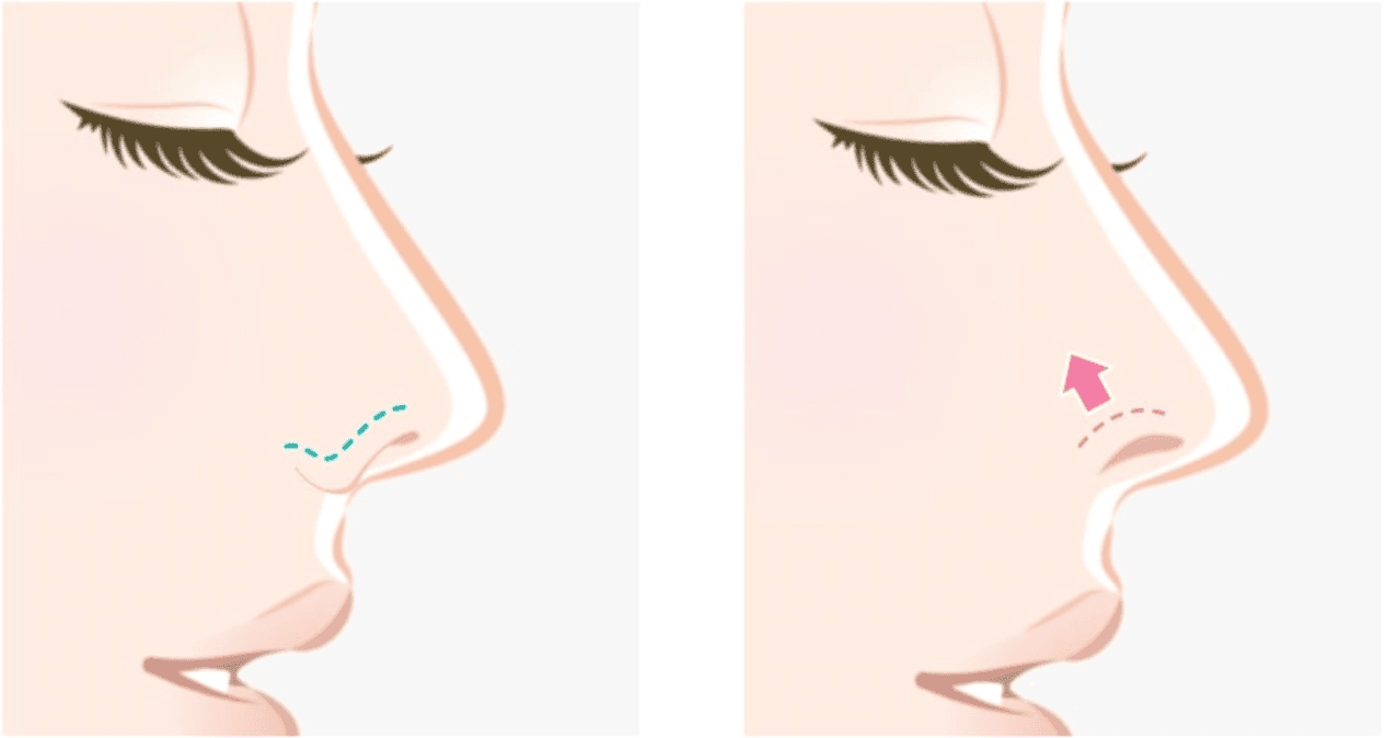 ◼️ Alar Rim Elevation Explained