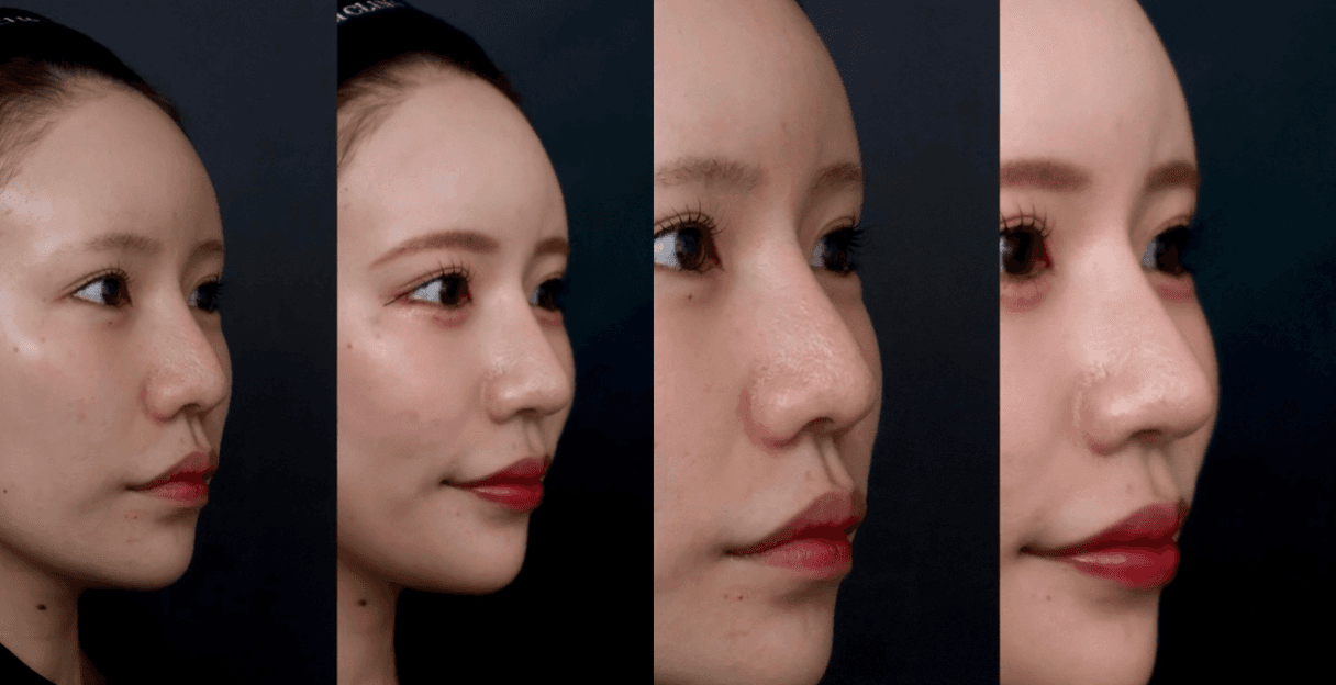 Before-and-After Photos: Nasal Tip Reduction + Auricular Cartilage Grafting + Alar Rim Elevation *Complex Revision Surgery