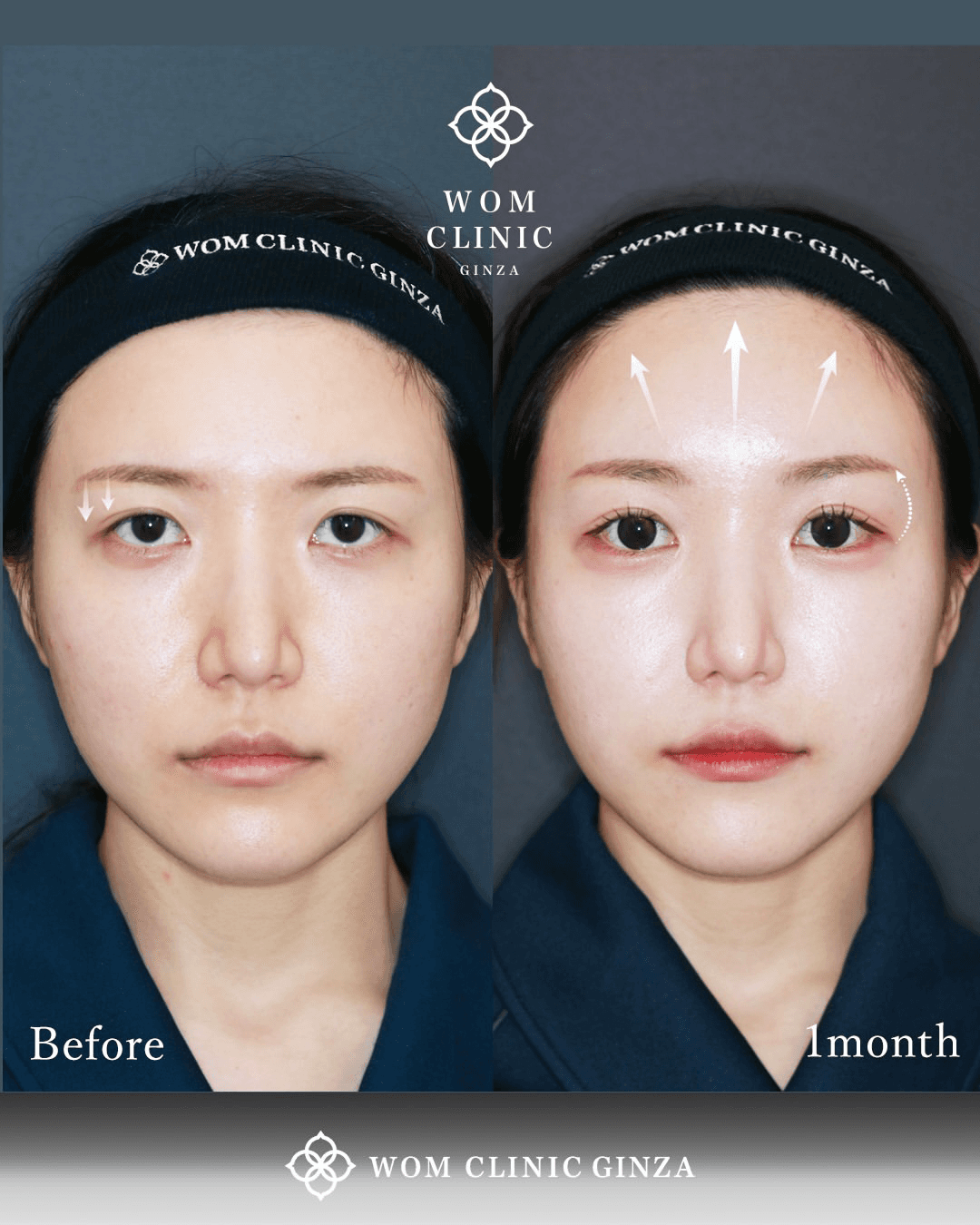 Front-view comparison before and one month after an endoscopic brow lift