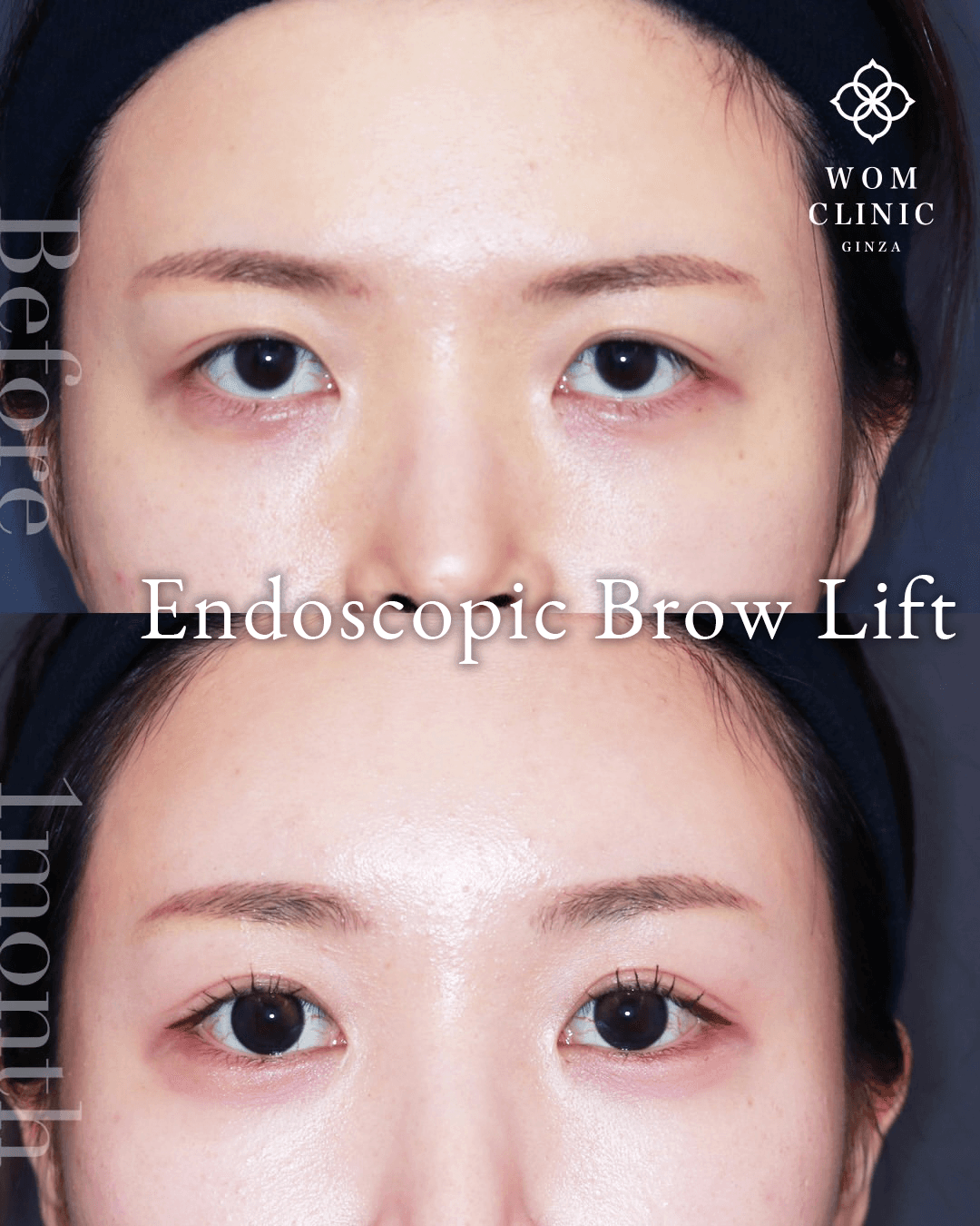 Before-and-after photos of an endoscopic brow lift at one month postoperative