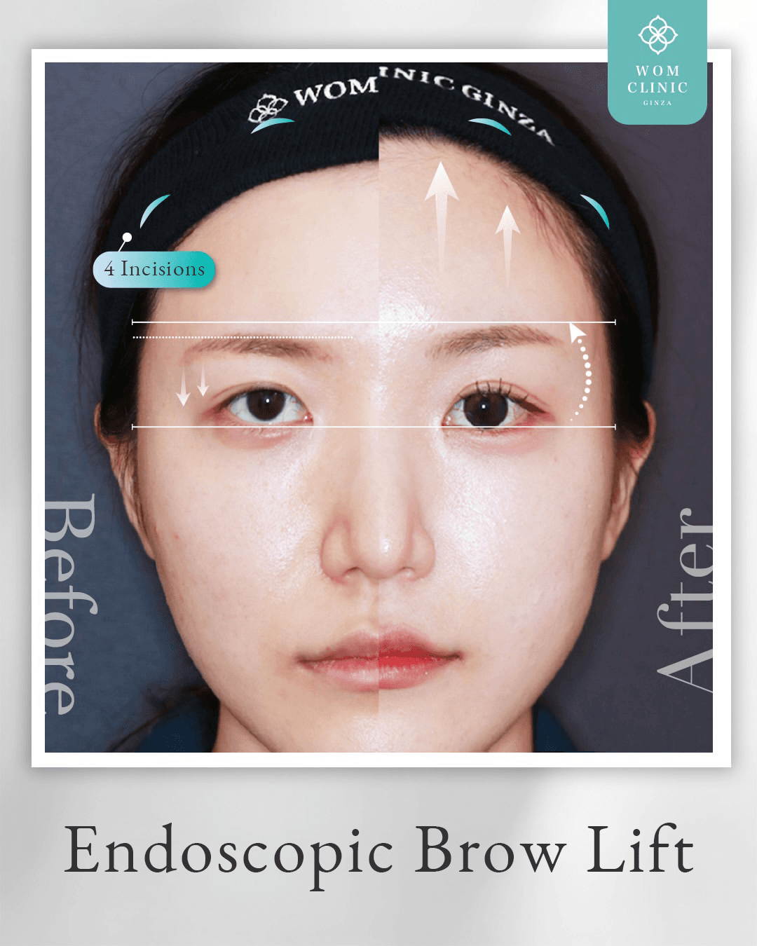 Scar locations for a hairline incision and an endoscopic brow lift