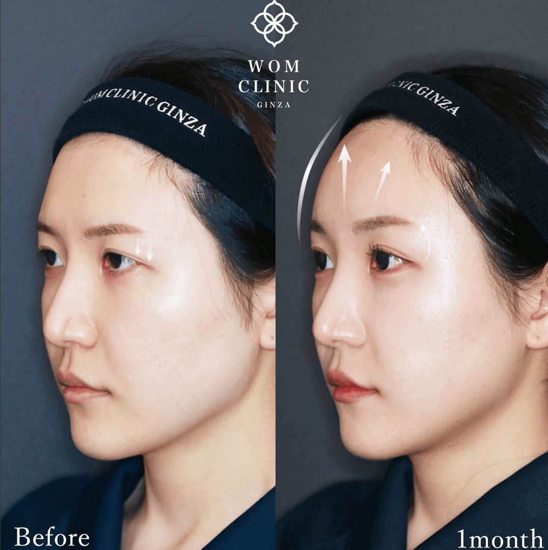 Oblique-view photos before and one month after an endoscopic brow lift