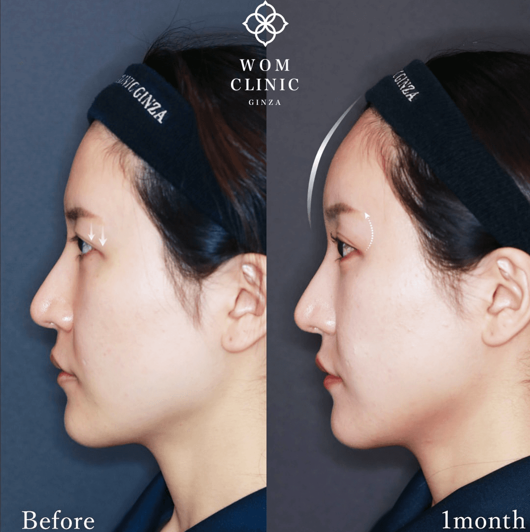 Profile-view photos before and one month after an endoscopic brow lift