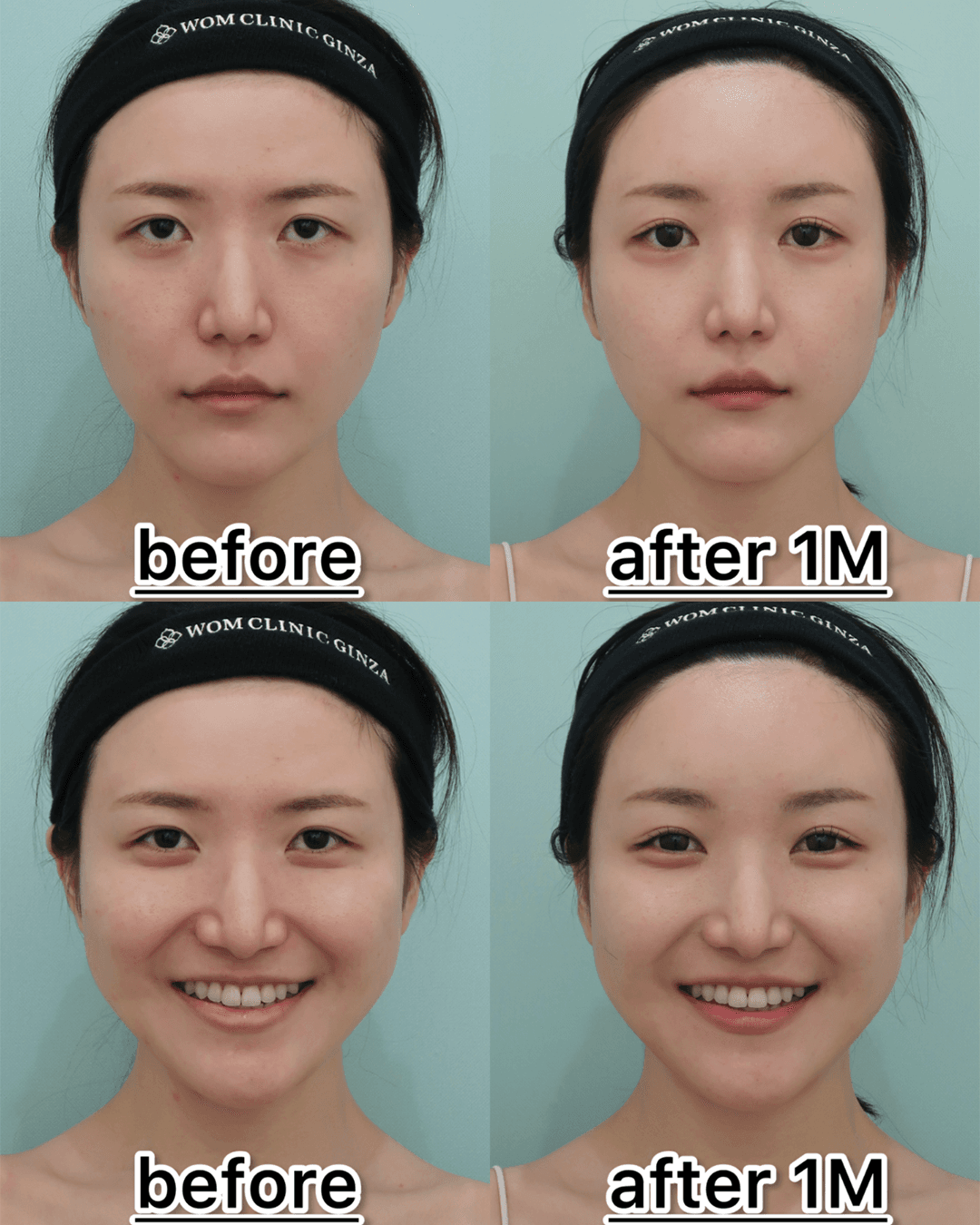 Photos showing a neutral expression and a smile before and one month after an endoscopic brow lift