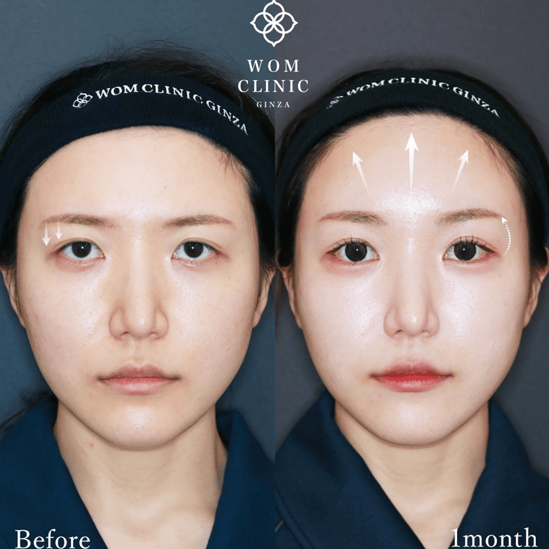 Case photos before and 1 month after an endoscopic forehead lift (brow lift) *Photos with a neutral expression and smiling