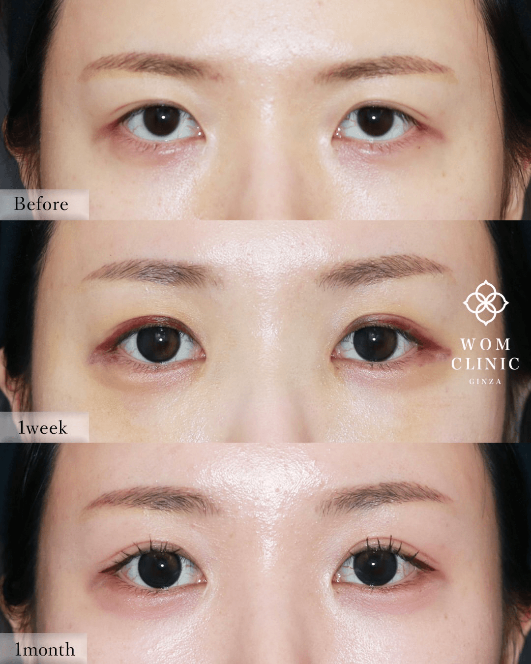 Recovery progress and time after an endoscopic brow lift (before surgery → 1 week → 1 month)