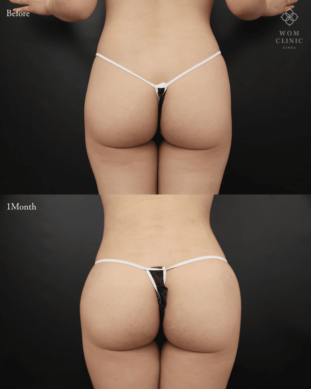 Brazilian butt lift before and one month after surgery