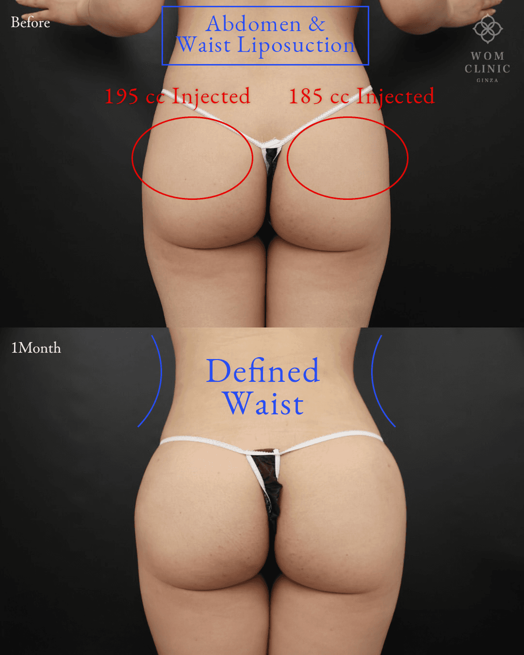 Brazilian Butt Lift (Condensed Fat Buttock Augmentation): before and one month after surgery