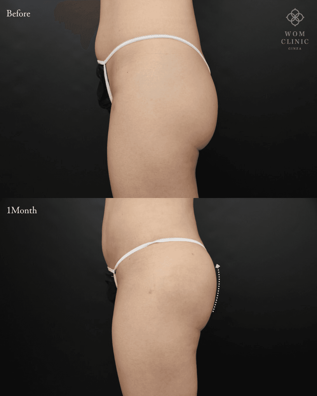Brazilian Butt Lift (Condensed Fat Buttock Augmentation): before and one month after surgery — side view